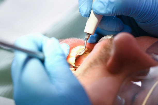 Best Emergency Dental Care for Abscessed Tooth in Oak Harbor, OH