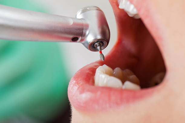 Best Emergency Dental Extractions in Oak Harbor, OH